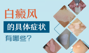 腿上長白癜風(fēng)有哪些癥狀?