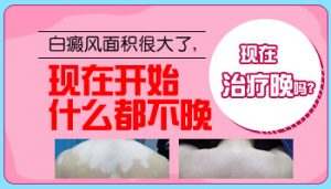 頸部白癜風(fēng)需要治療嗎?