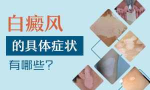 兒童白癜風(fēng)的癥狀是什么?