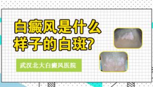 如何診斷和識(shí)別白癜風(fēng)?
