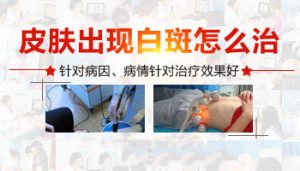 頸部白癜風(fēng)需要治療嗎?