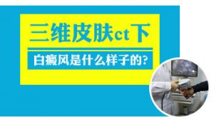 老年人腿部白斑一定是白癜風(fēng)嗎?