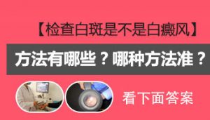 檢查白癜風(fēng)要多少錢?