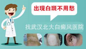為什么女性比男性更容易患白癜風(fēng)呢